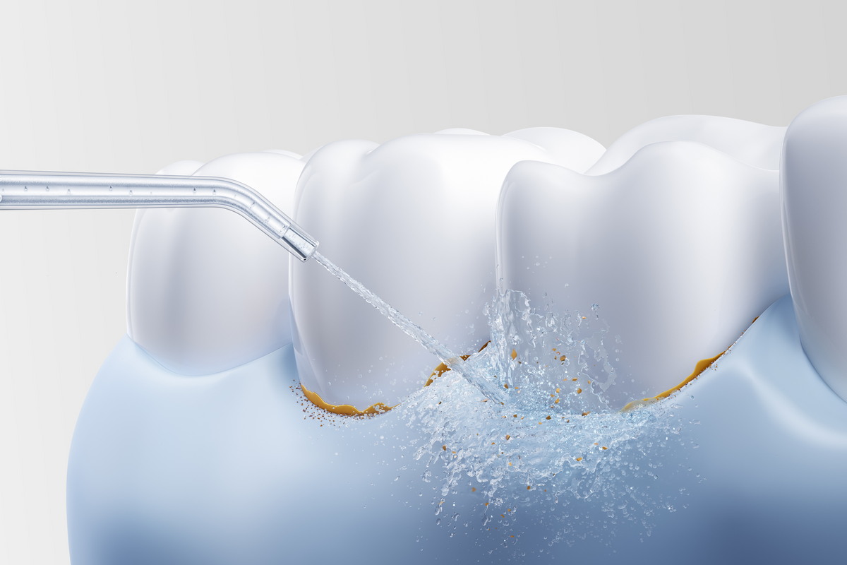 Innovative Micro-Bubble Flossing